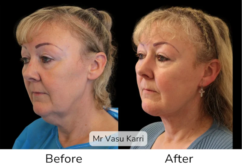 Facelift Patient 20 View 1